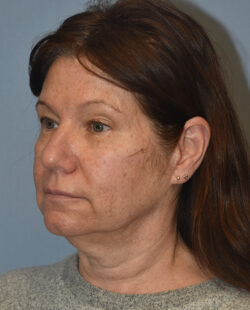 Facelift