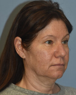 Facelift
