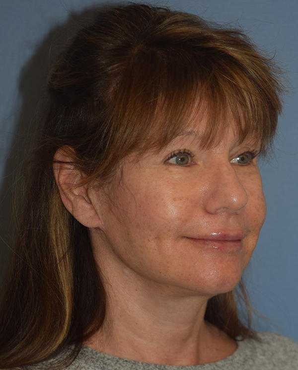 Facelift