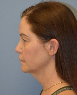 Facelift