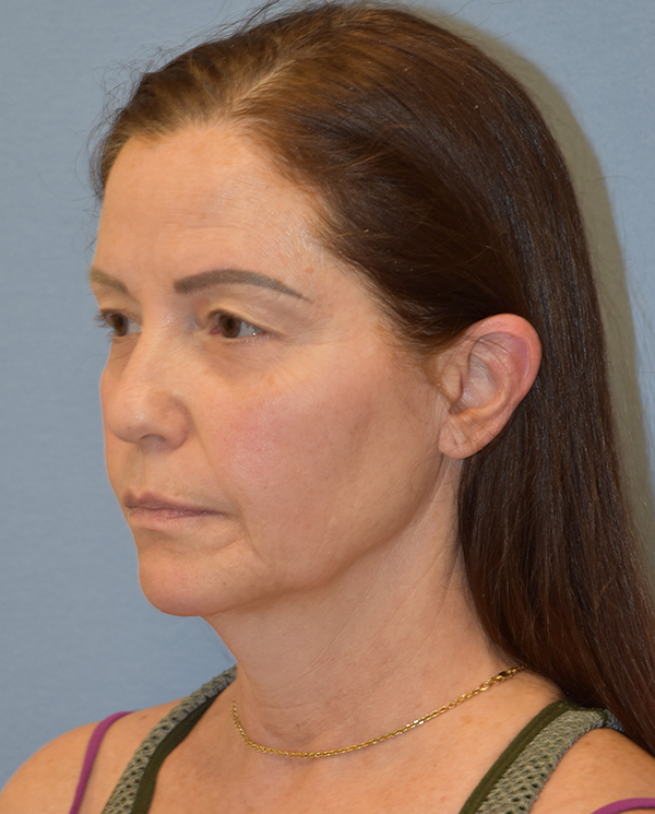 Facelift