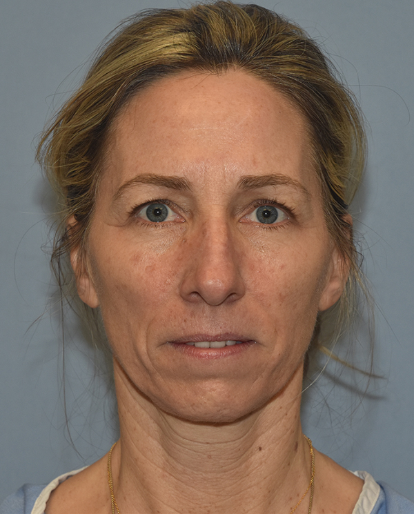 Facelift
