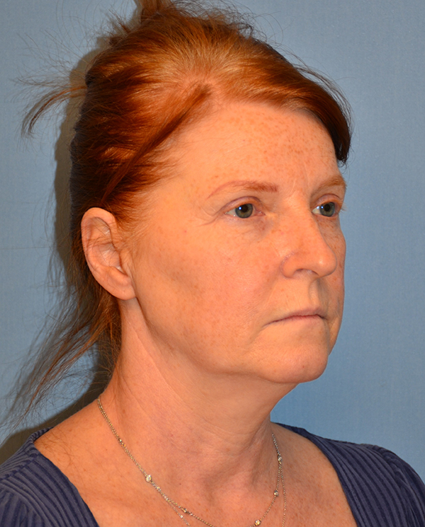Facelift