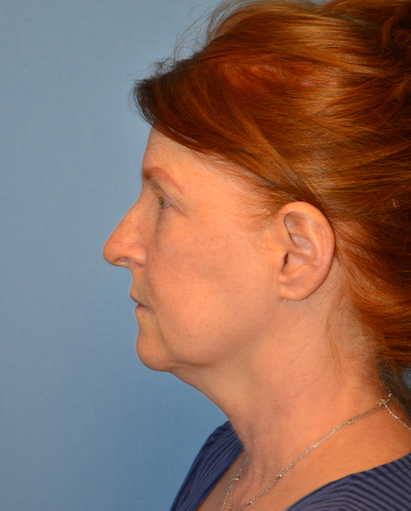 Facelift