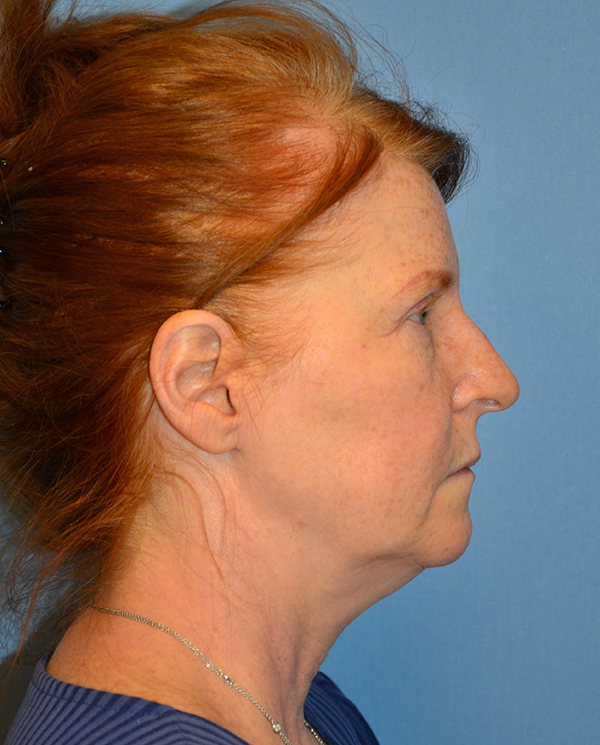 Facelift