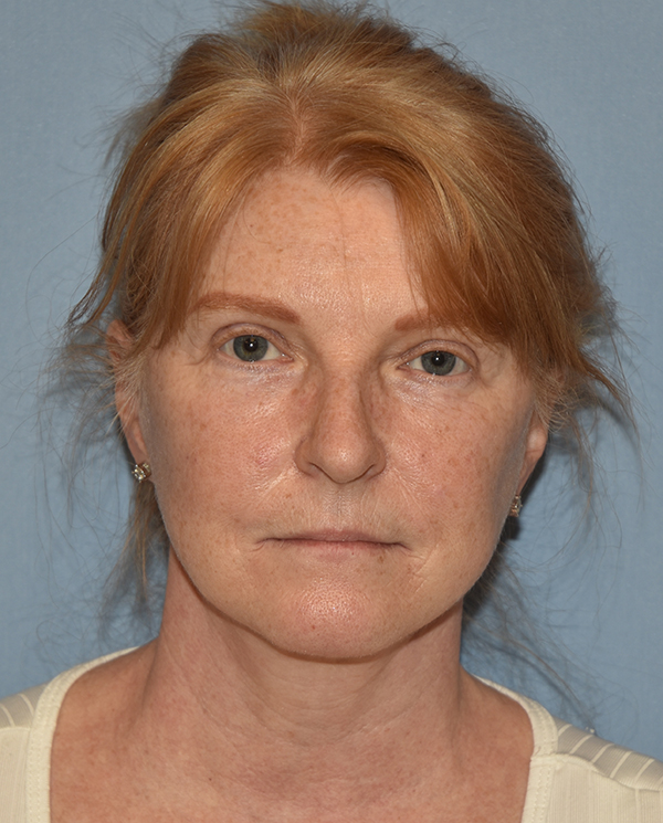 Facelift