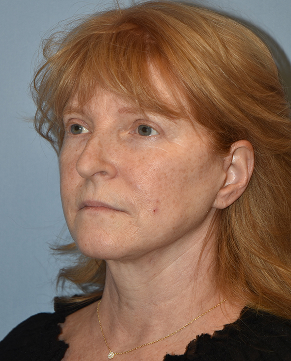 Facelift