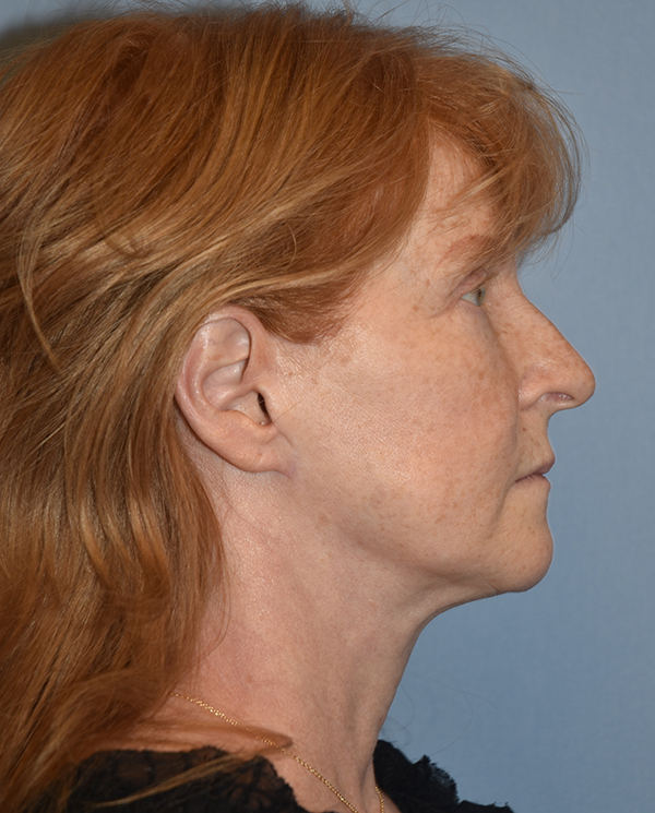 Facelift