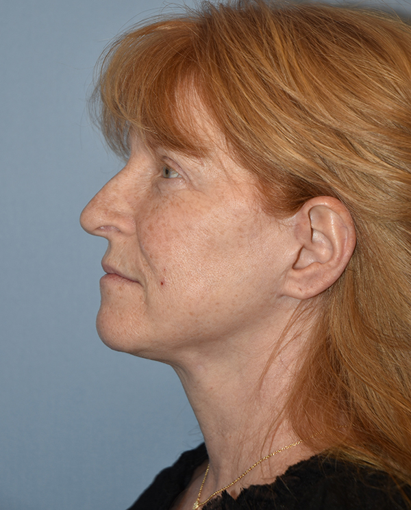 Facelift