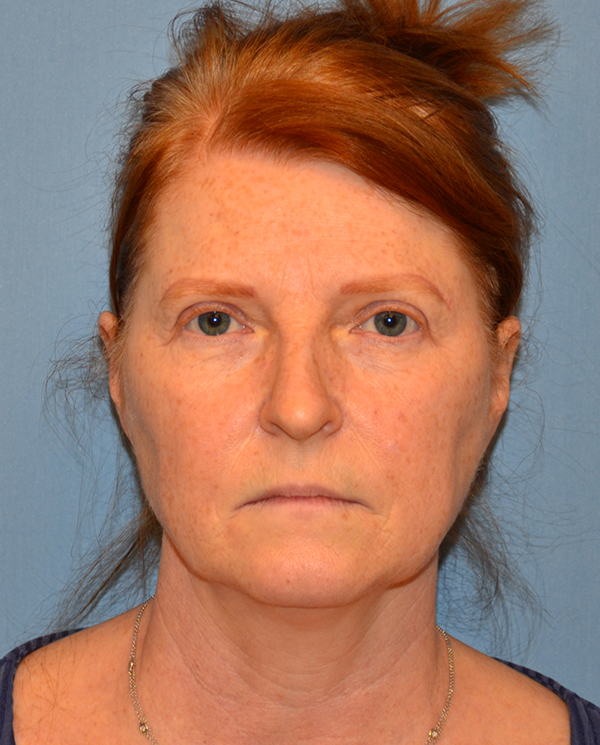 Facelift