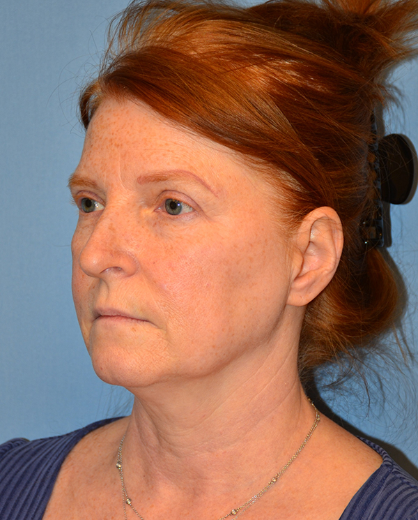 Facelift