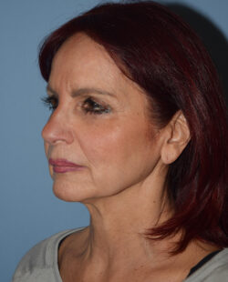 Facelift