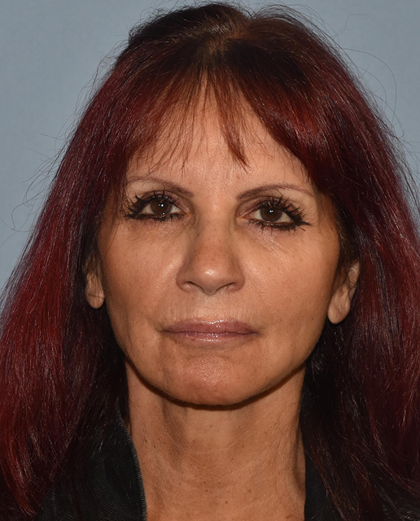 Facelift