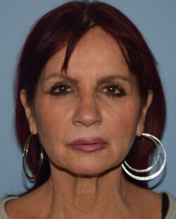 Facelift