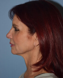 Facelift