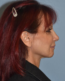 Facelift