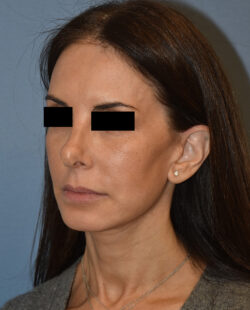 Facelift