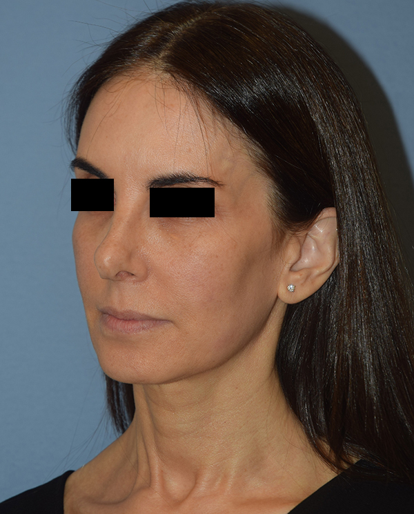 Facelift
