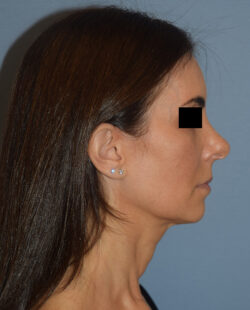 Facelift