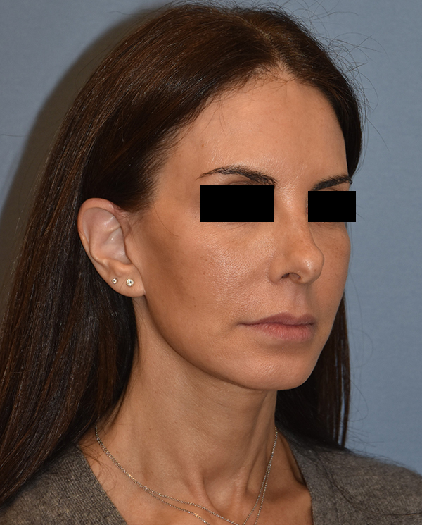 Facelift