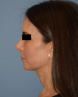 Facelift