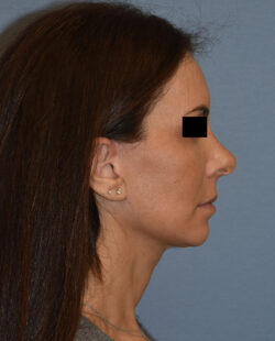 Facelift