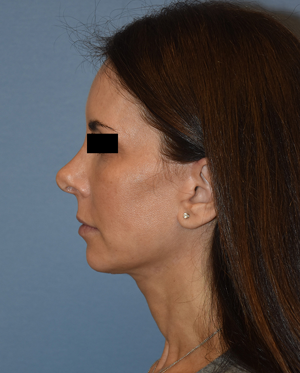 Facelift