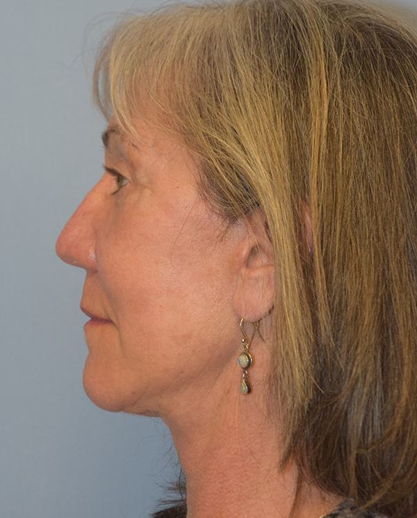 Facelift