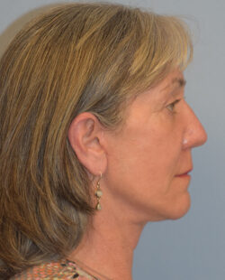 Facelift