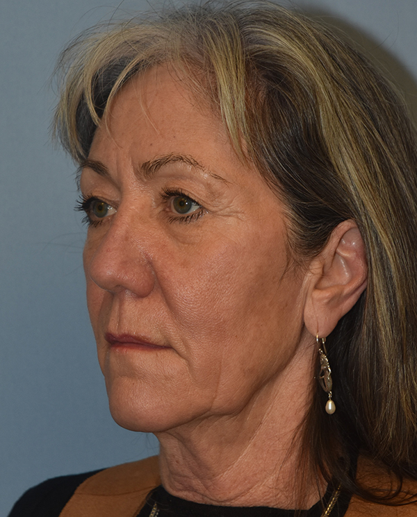 Facelift