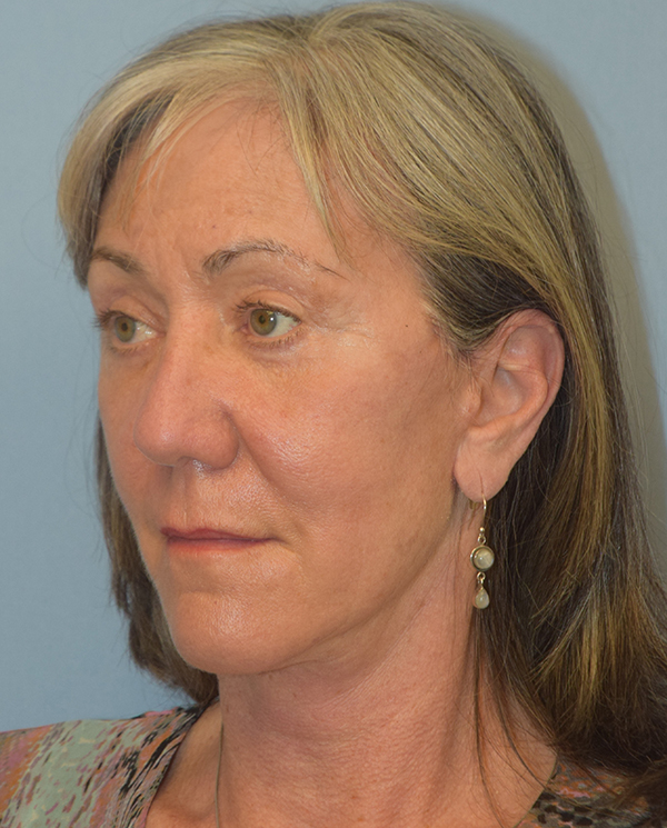 Facelift
