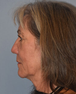 Facelift