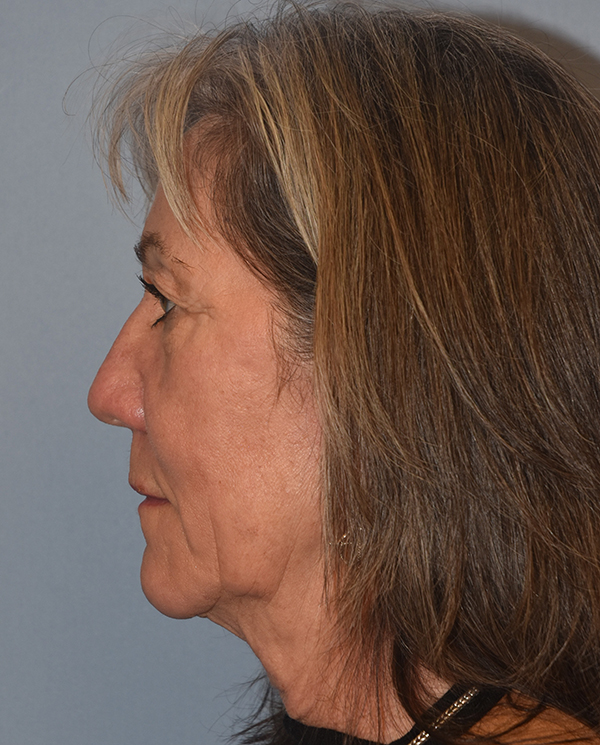 Facelift