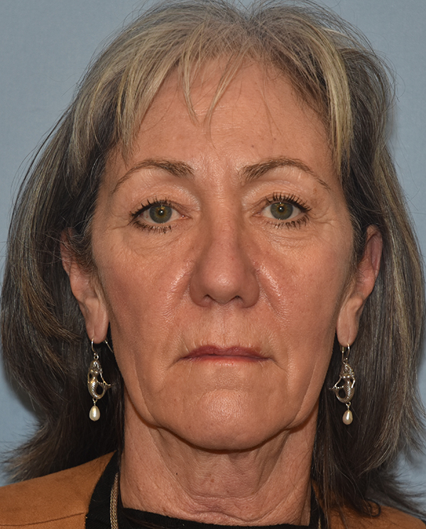 Facelift