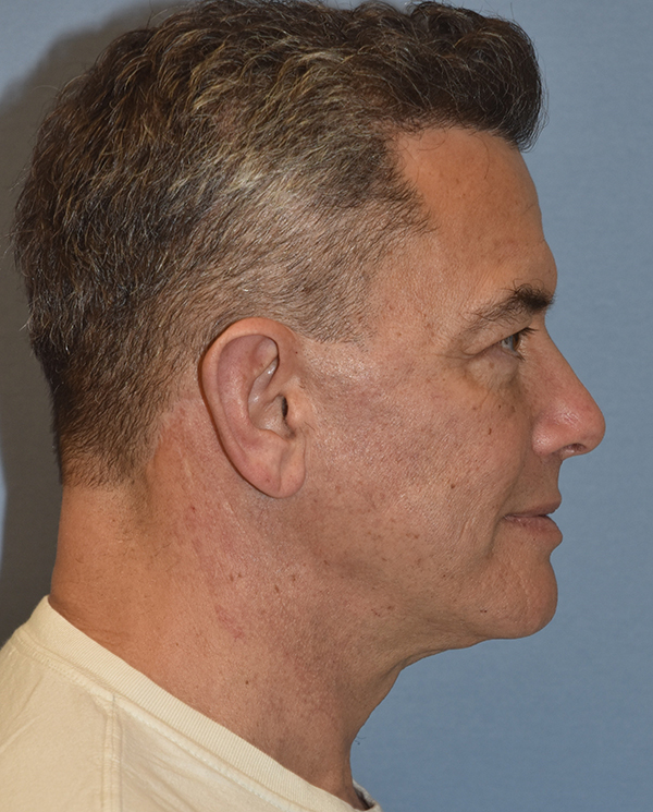 Facelift