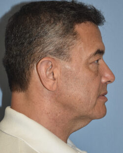 Facelift