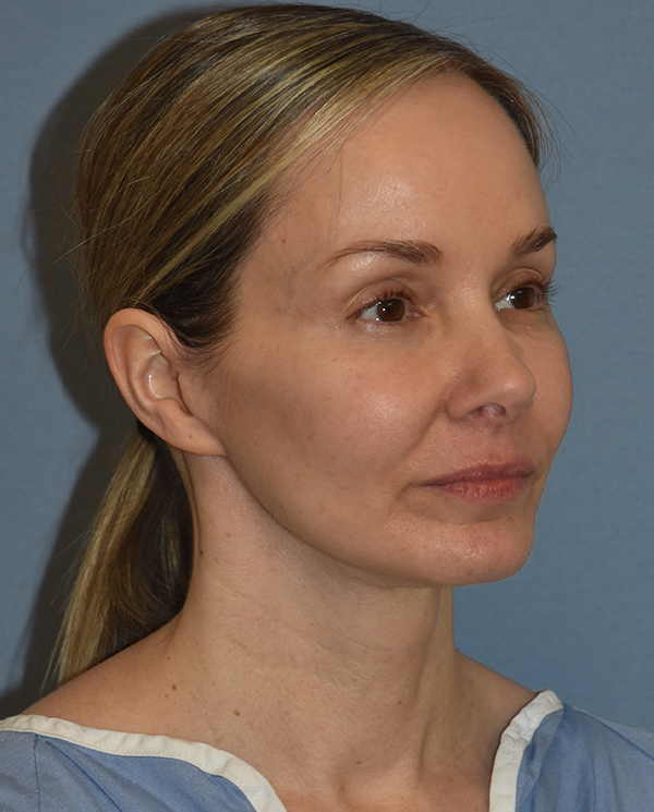 Facelift