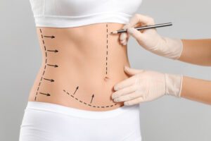  Tummy Tuck in Melville, NY 
