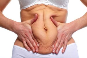 How can I prepare for my Tummy tuck procedure in Melville, NY